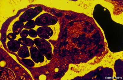 blood cell with malaria parasites