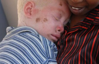 albino malawi albino malawi