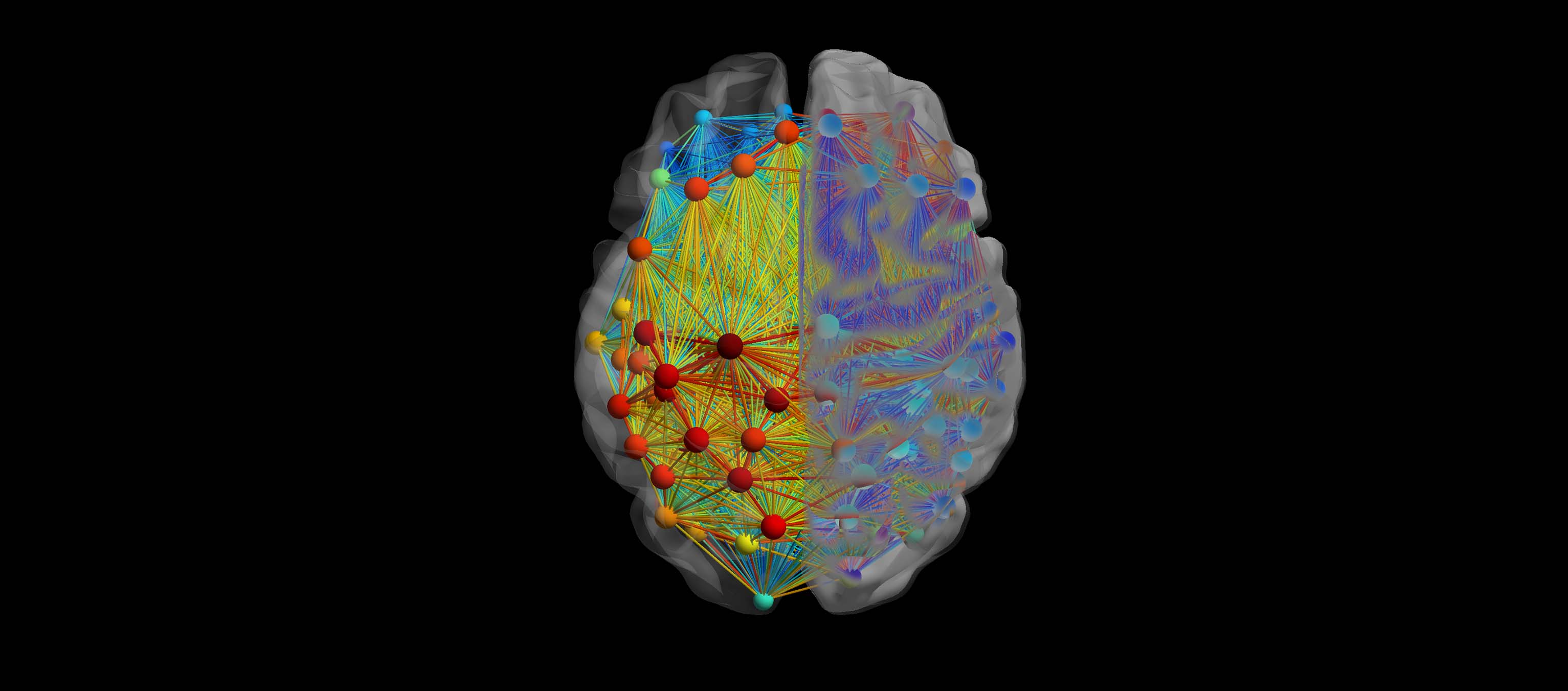 Brain Aneurysm