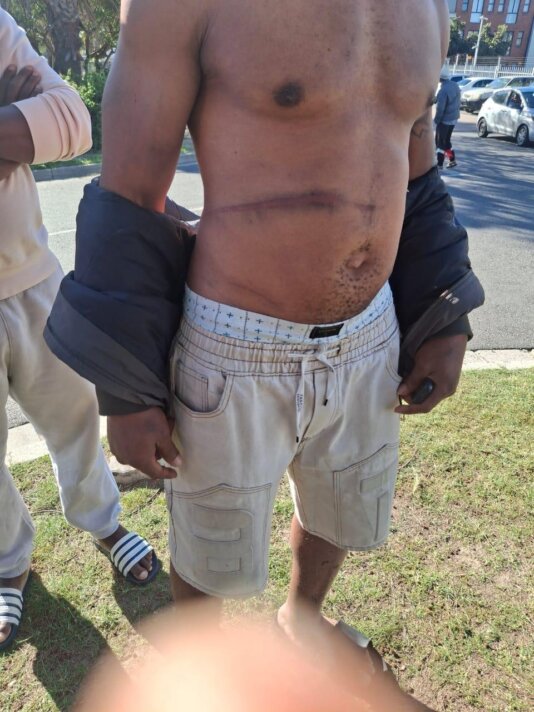 A Nigerian who sustained injury after South Africans flogged him in June