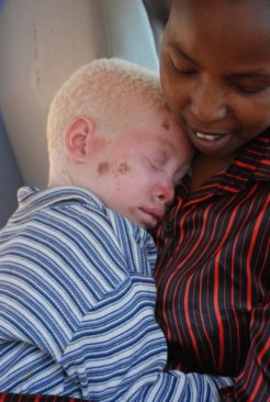 albino malawi