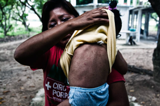 Another Capoacan neighbour shows the effects on the skin of her son. Another Capoacan neighbour shows the effects on the skin of her son.