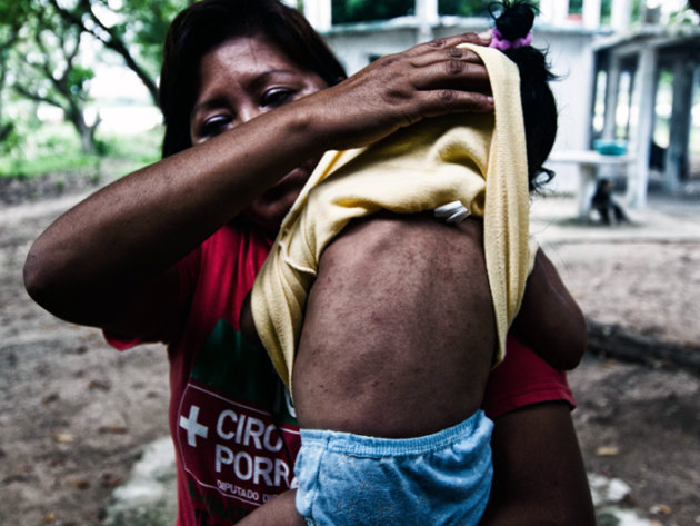 Another Capoacan neighbour shows the effects on the skin of her son. Another Capoacan neighbour shows the effects on the skin of her son.