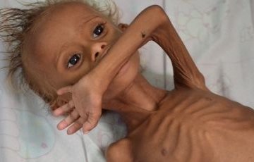 Yemen_Hunger crisis Yemen_Hunger crisis