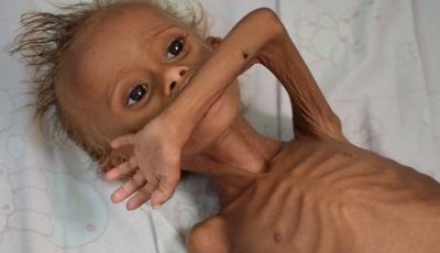 Yemen_Hunger crisis Yemen_Hunger crisis
